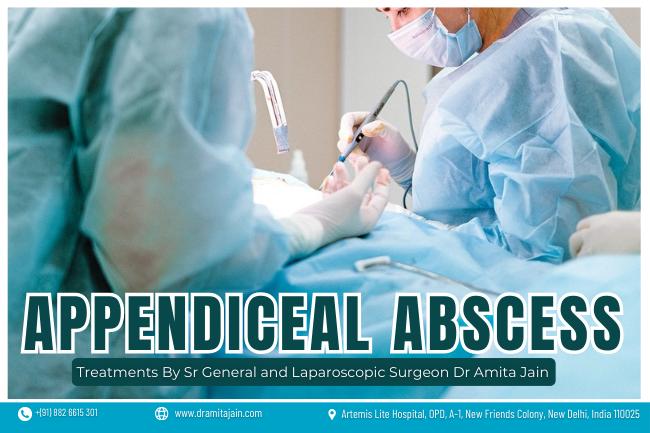 Dr Amita Jain surgeon for Appendiceal Abscess